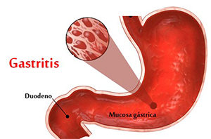 infiammazione della mucosa nella gastrite
